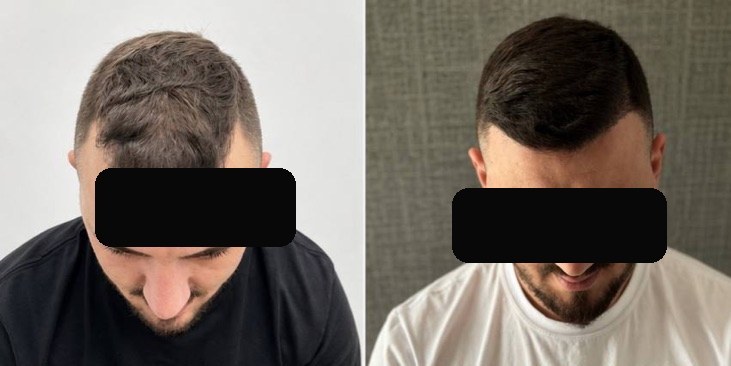 Injerto capilar — caso real antes y después