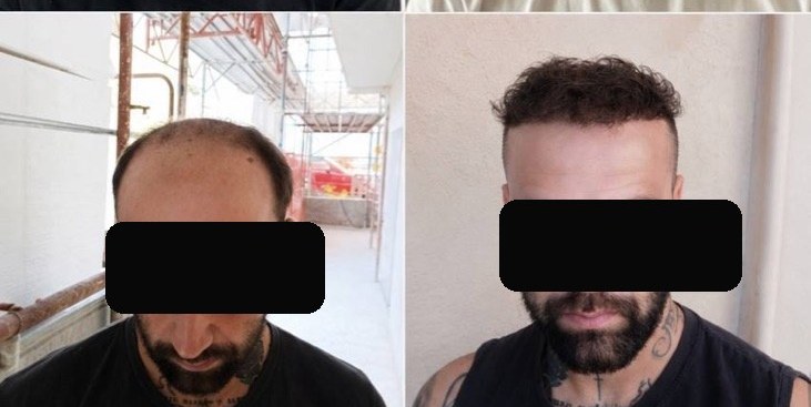 Injerto capilar — caso real antes y después