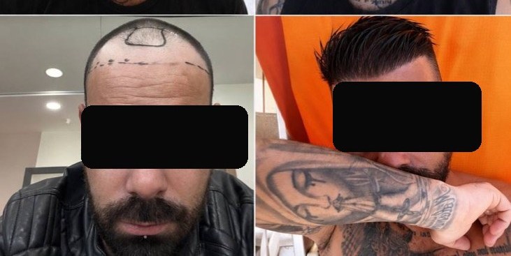 Injerto capilar — caso real antes y después