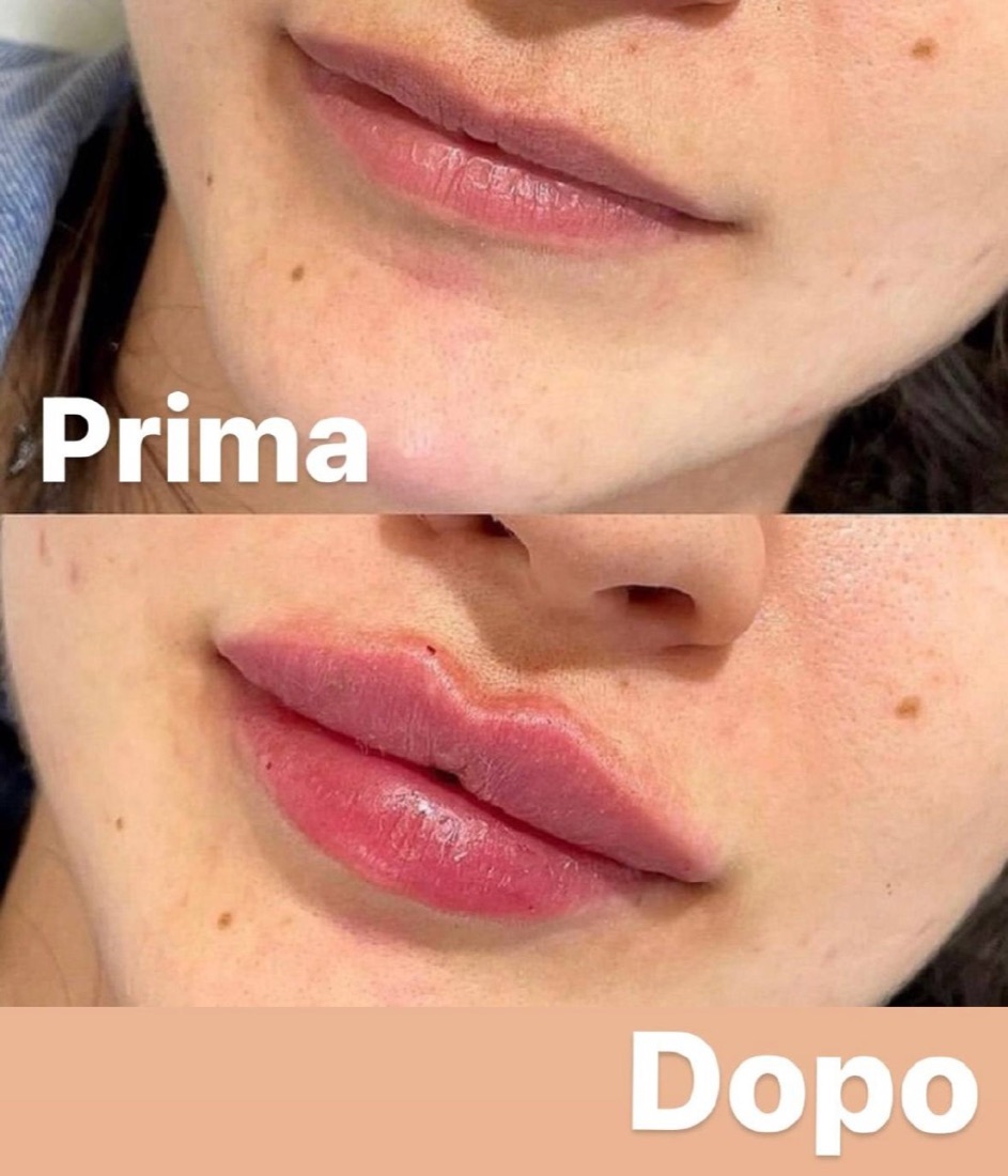 Relleno de labios — Antes y Después