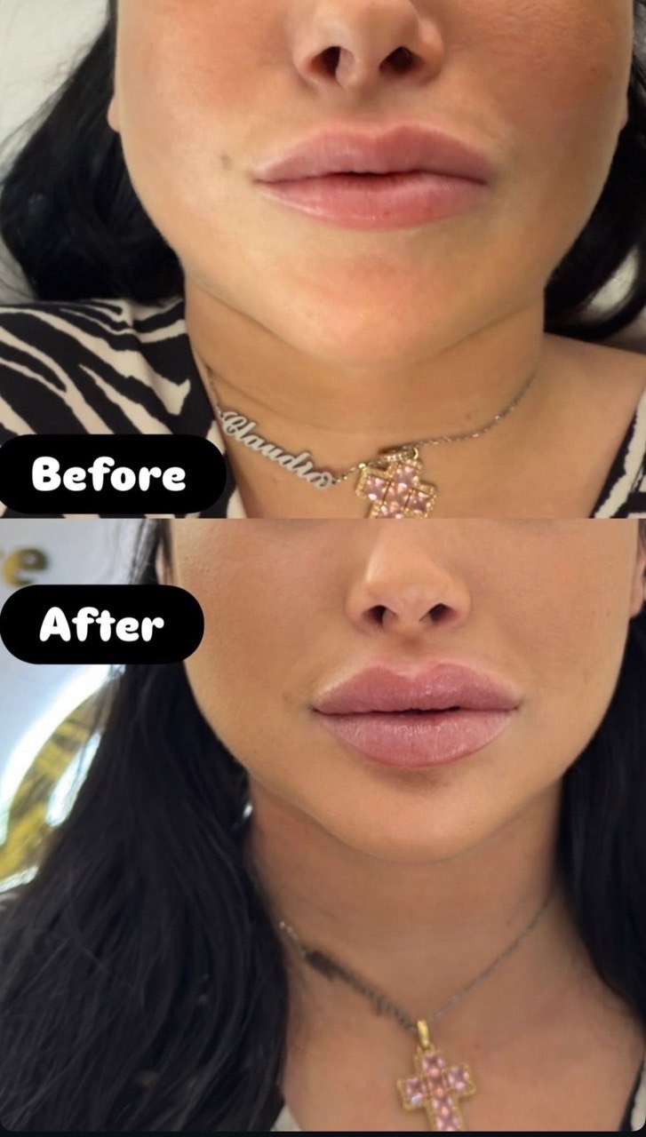 Relleno de labios — Antes y Después, segundo caso real