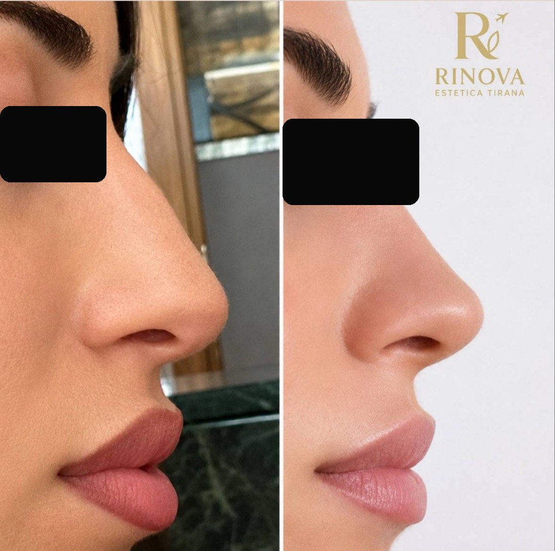 Rinoplastia — caso real antes y después