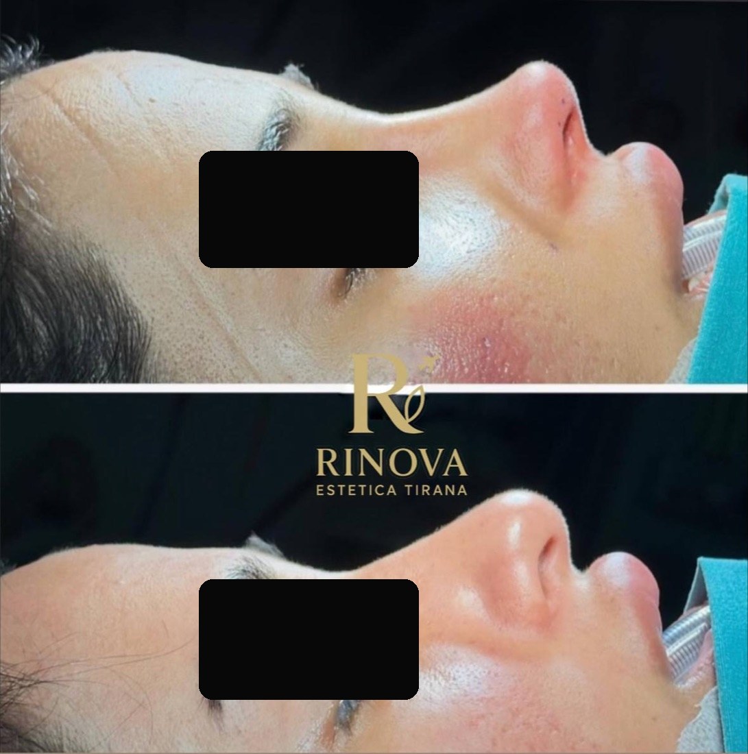 Rinoplastia — caso real antes y después