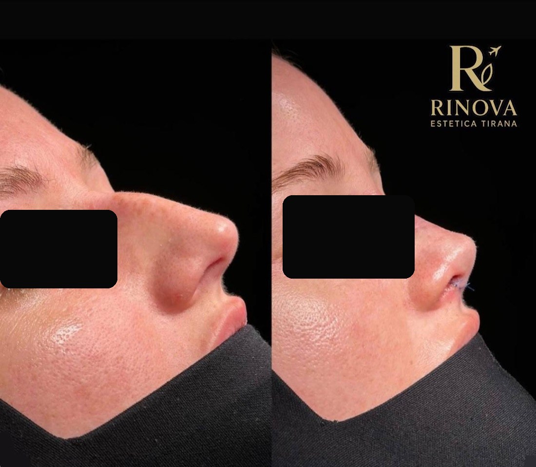 Rinoplastia — caso real antes y después