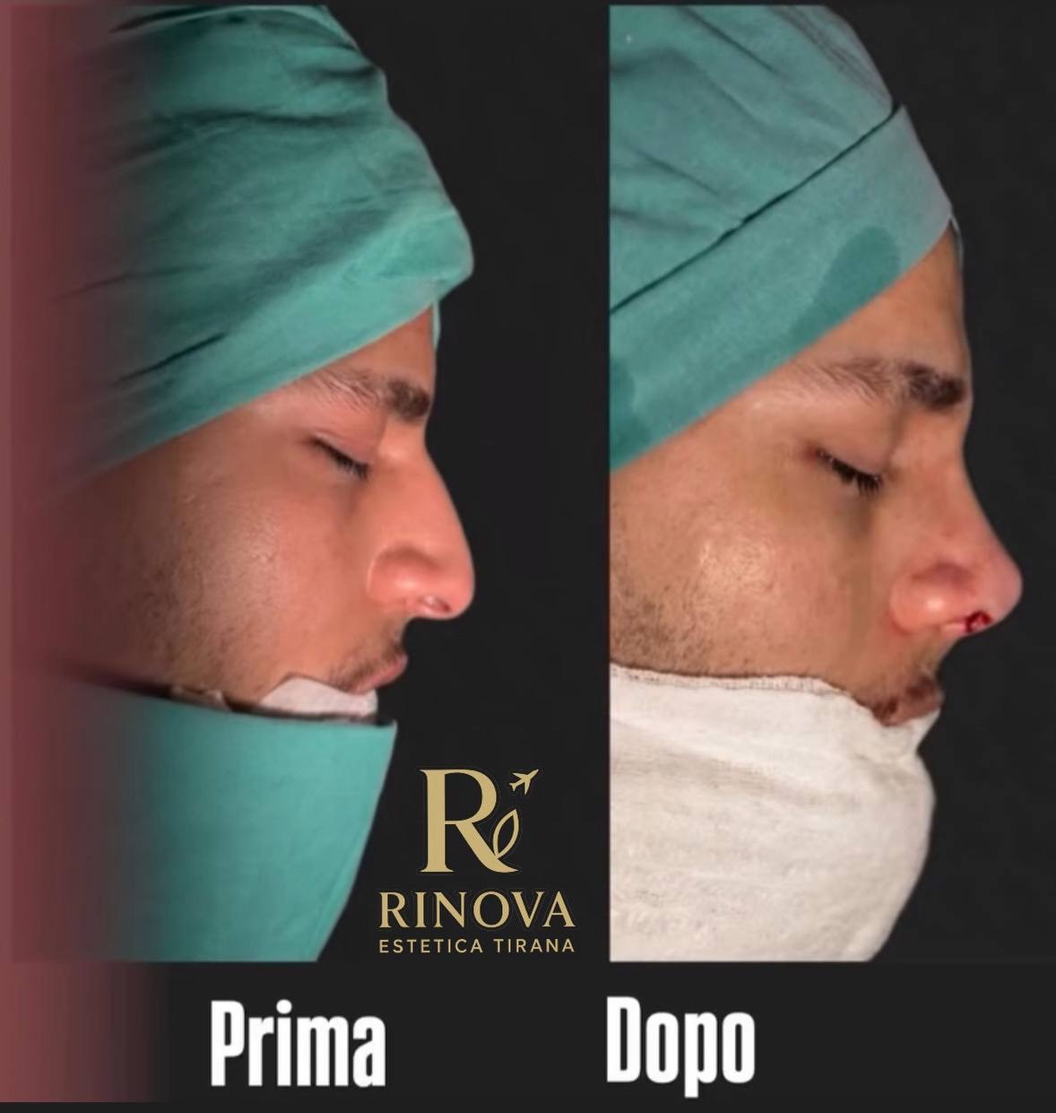 Rinoplastia — antes e inmediatamente después de la intervención