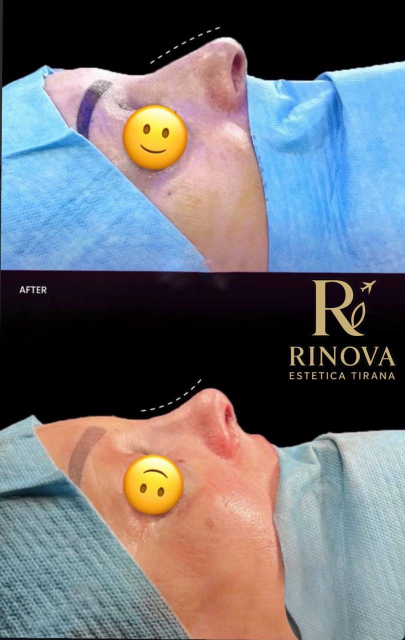 Rinoplastia — comparación clínica perioperatoria