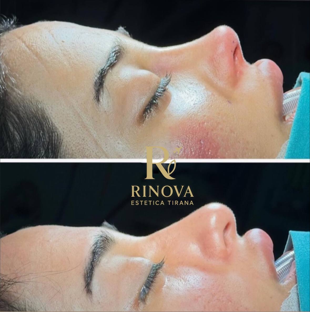 Rinoplastia — caso real antes y después